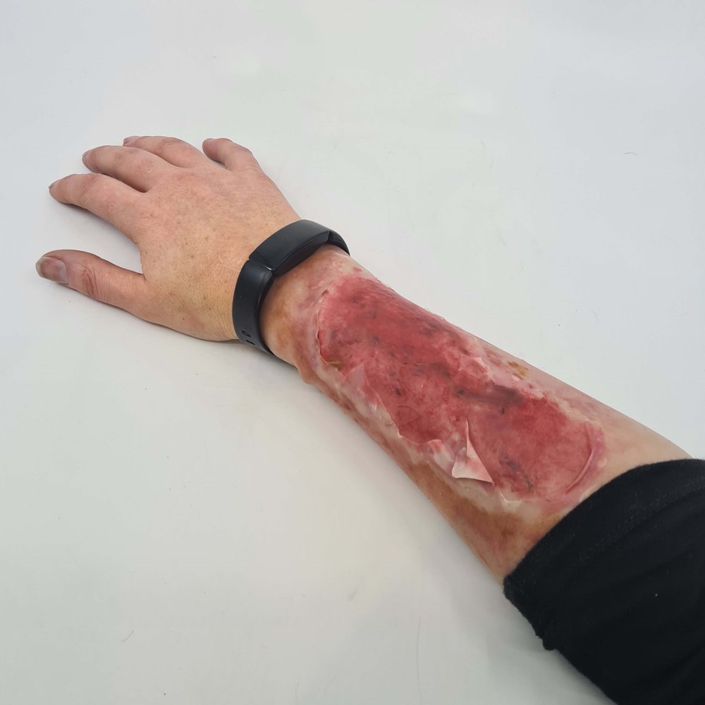M04 – MedicFX – Scalding Burn Sleeve
