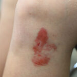 TC-Bruises-1 A