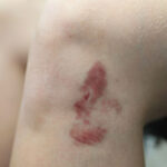TC-Bruises-1 B