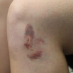 TC-Bruises-1 C