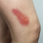 TC-Bruises-2 A