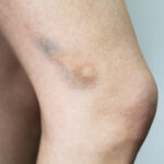 TC-Bruises-2 C
