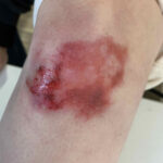 TC-Random-Wounds 2
