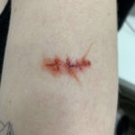 TC-Scars-and-Sutures B