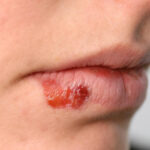 TC-Skin-Diseases