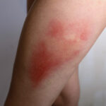 TC-Bruises-3 A