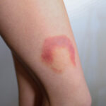 TC-Bruises-3 B
