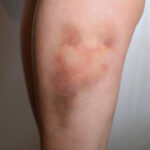 TC-Bruises-3 C
